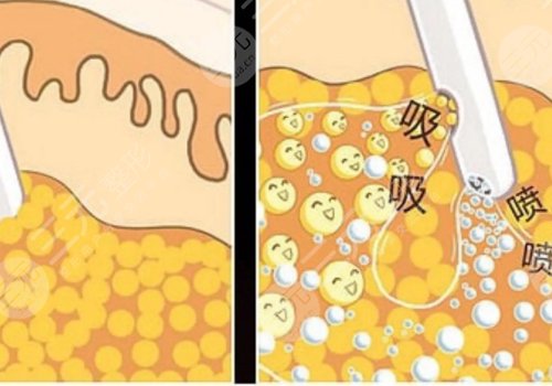 小腿吸脂后多久可以正常走路？