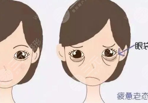 眼袋是怎么產(chǎn)生的？如何消除眼袋？