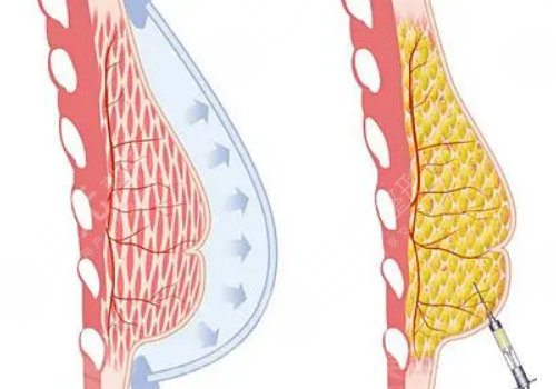豐胸手術對身體有什么影響？