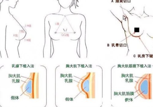 豐胸手術對身體有什么影響？