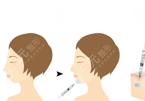 寶尼達(dá)玻尿酸適合注射在什么部位？