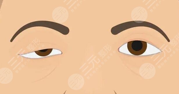 上瞼下垂矯正手術(shù)一般多少錢(qián)一次?