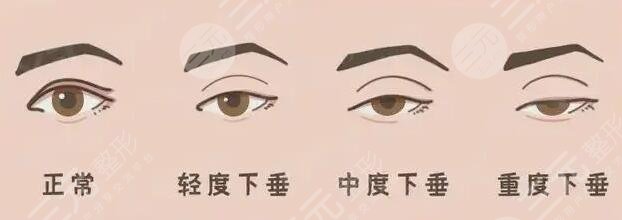 上瞼下垂矯正手術(shù)一般多少錢(qián)一次?