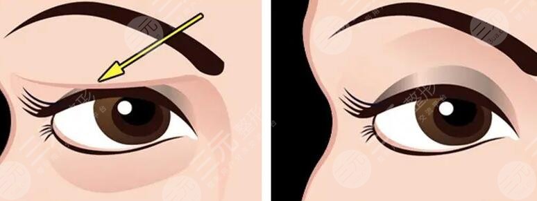 上瞼下垂矯正手術(shù)的價(jià)格范圍