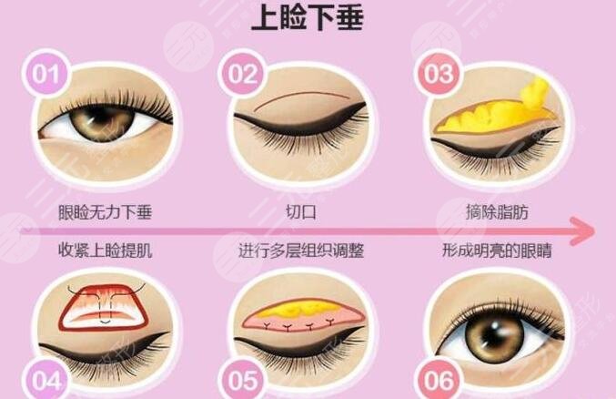 上瞼下垂矯正手術(shù)后注意事項(xiàng)
