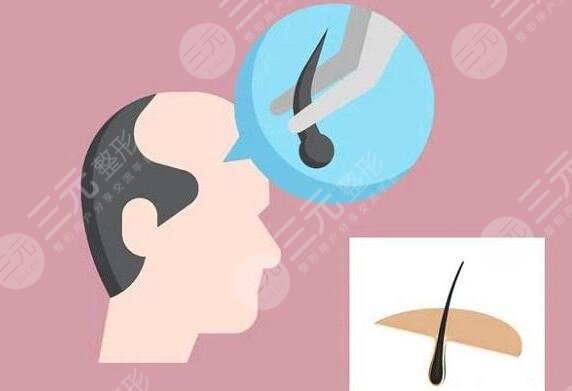 毛發(fā)種植的費(fèi)用是多少2023？?jī)r(jià)格影響根源所在，30秒速覽~
