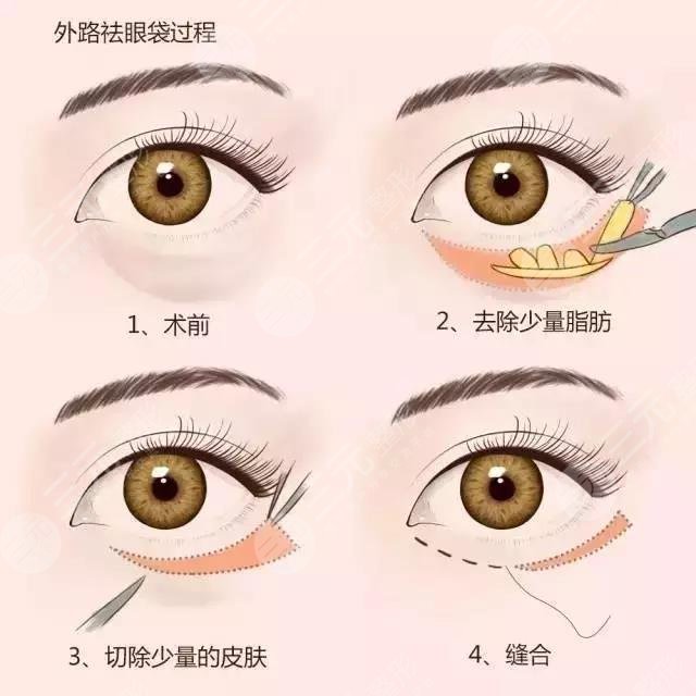 眼袋是怎么產(chǎn)生的？如何消除眼袋？