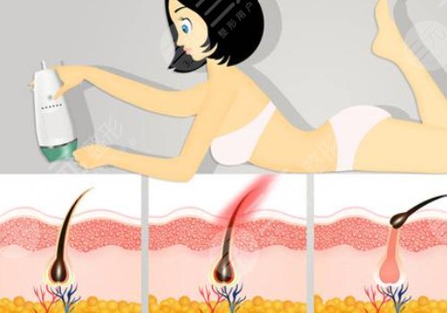 激光脫毛幾次能永久脫毛？