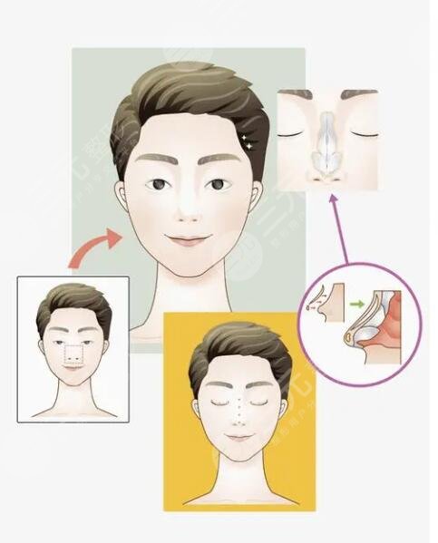 李愛(ài)林做鼻子怎么樣？醫(yī)生資料詳情、手術(shù)風(fēng)格夸張嗎？整友術(shù)后反饋來(lái)襲~