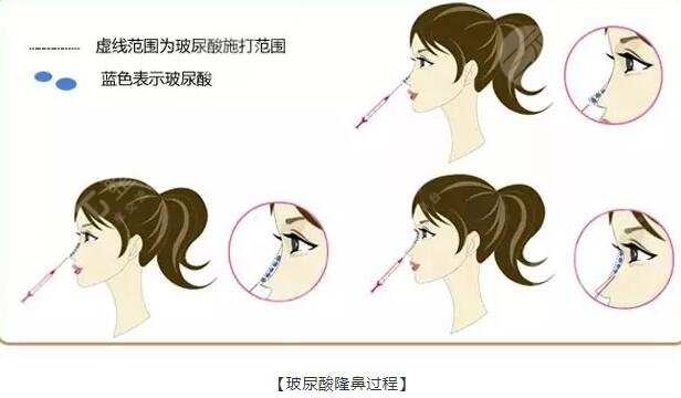 玻尿酸隆鼻的種類(lèi)及原理