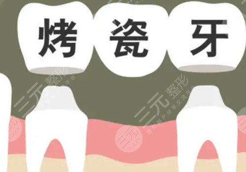 鈷鉻烤瓷牙套怎么樣？