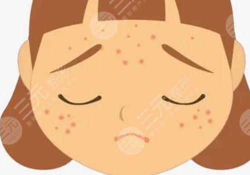 如何去除臉上的青春痘？