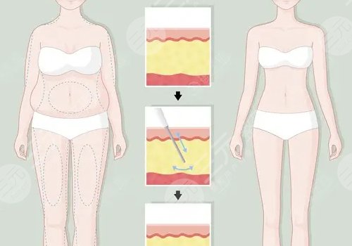 產(chǎn)后吸脂減肥好嗎？