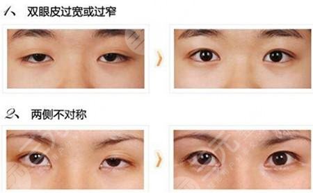 雙眼皮修復(fù)大概多少錢呢？