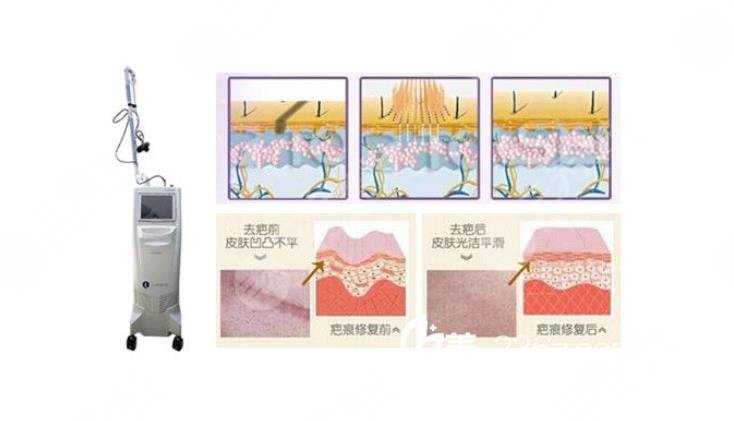 有傷疤怎么去掉？