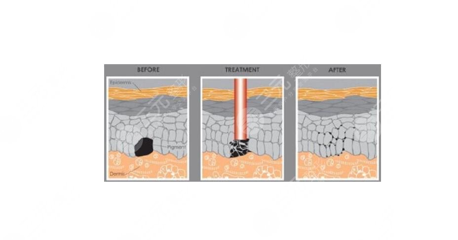 有傷疤怎么去掉？