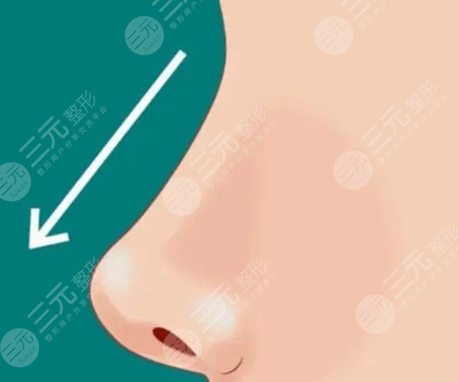 強(qiáng)生瑆珀假體缺點(diǎn)有哪些？適合鼻梁還是鼻尖？能夠在體內(nèi)放多久？