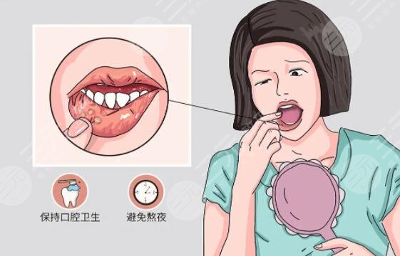 　　快速治口腔潰瘍偏方都有哪些?口腔潰瘍的發(fā)生，給我們的口腔內(nèi)部帶來了很大的困擾。對于經(jīng)常性和突發(fā)性的口腔潰瘍患者來說，掌握一些快速緩解口腔潰瘍的小辦法，就會得到比較好的緩解效果。為了滿足我們廣大朋友的現(xiàn)實(shí)需求，小編就整理了幾個緩解口腔潰瘍的小辦法。在這篇文章中，有著比較詳細(xì)的介紹。有需求的朋友可以參考一下。  　　1、快速治口腔潰瘍偏方有哪些?  　　口腔潰瘍的出現(xiàn)也是有多種情況引起的?？谇粷兊某霈F(xiàn)，也會引起我們身體各方面的不適癥狀。而出現(xiàn)這種癥狀，我們就采用一些緩解偏方來緩解。常用的方法就有姜水漱口、維生素B2、濃茶漱口、蘿卜藕汁、維生素C片等等多個方面。  　　(1)、姜水漱口：姜水漱口，也是比較常用的一種方法。在采用姜水漱口的過程中，首先將姜片放在水中進(jìn)行加熱，在這個過程中，就能夠?qū)⒔锩娴奈镔|(zhì)熬在水中。熬好的姜片，每日漱口3次左右，漱口8次左右，就會有了明顯的好轉(zhuǎn)。  　　(2)、濃茶漱口。濃茶漱口作為比較易操作的一種方式，在口腔潰瘍緩解偏方中，也是深受廣大朋友所喜歡的。只需要加高茶葉的濃度，然后漱口即可。這種方法雖然簡單易操作，但是在緩解和緩解周期上，相比較長，需要堅(jiān)持一段時間后，就會得到好的效果。  　　(3)、維生素C片。維生素C片，是比較見效比較快的緩解口腔潰瘍的好方法。在緩解的過程中，只需將維生素C片壓成粉末，然后涂在患處，這樣有幾次后，就會得到明顯的好轉(zhuǎn)和。  　　(4)、蘿卜藕汁:蘿卜藕汁，也是比較常用緩解口腔潰瘍的好方法。就是取生蘿卜2只，鮮藕一段洗凈搗爛絞汁去渣，用汁含漱，每日3次，連用4天可見效。  　　2、口腔潰瘍需要注意事項(xiàng)有哪些?  　　口腔潰瘍發(fā)生后，首先需要注意的是，飲食問題。在飲食中，要注意以清淡為主，不要吃刺激性的食物。過熱，過涼的食物，也不要吃。另外，就是在這個階段中，還需要注意的是養(yǎng)成良好的生活習(xí)慣。不抽煙，不喝酒，不經(jīng)常坐在電腦桌前，還可以做一些適量的運(yùn)動。這些都是有助于口腔潰瘍的緩解辦法的。  　　在這篇文章中，為大家詳細(xì)的介紹了有關(guān)口腔潰瘍的緩解辦法以及小妙招。對于一些簡單的操作方法，我們廣大有需求的朋友可以嘗試一下。相比較嚴(yán)重的朋友，還是建議去醫(yī)院進(jìn)行檢查，接受正規(guī)的緩解。另外就是，在緩解口腔潰瘍的同時，我們應(yīng)該注意的問題。這些直接或者間接的影響到口腔潰瘍的緩解時效。有需求的朋友可以參考一下。