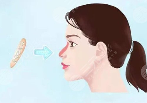 鼻梁山根低怎么辦？