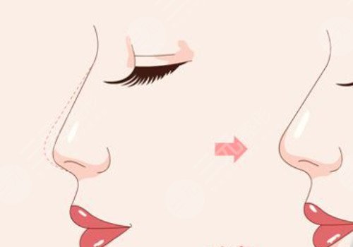 媽生鼻和直鼻微翹的區(qū)別是什么？