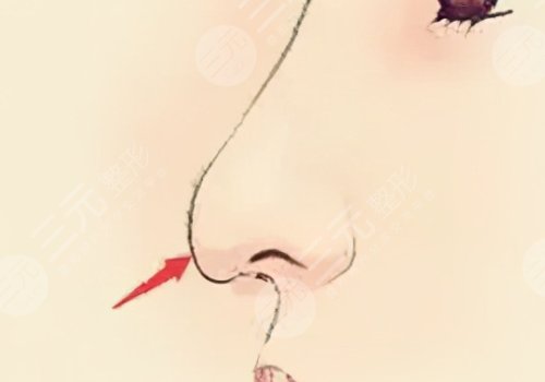 媽生鼻和直鼻微翹的區(qū)別是什么？