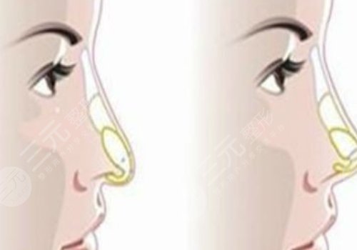 媽生鼻和直鼻微翹的區(qū)別是什么？