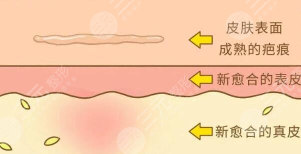像素激光去疤痕要做多少次才會(huì)好?