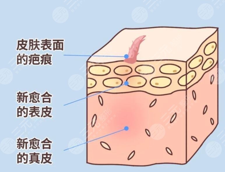 像素激光去疤術(shù)后注意事項(xiàng)