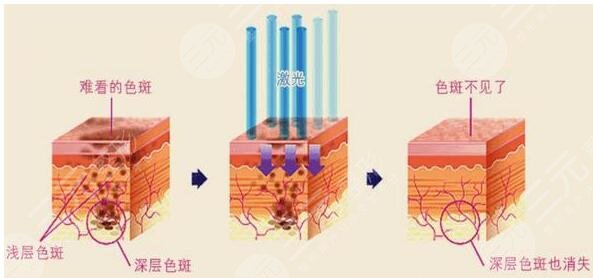激光祛斑多少錢(qián)?