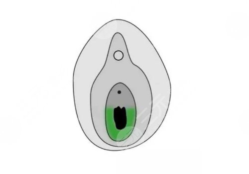 補(bǔ)處膜修復(fù)后會(huì)出血嗎？