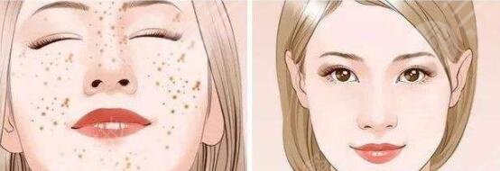 激光祛斑會(huì)不會(huì)反彈?