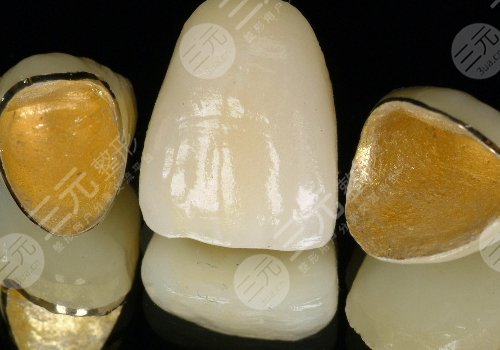 鈦合金烤瓷牙多少錢一顆？