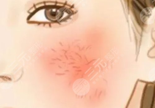 臉上長紅血絲怎么去掉？