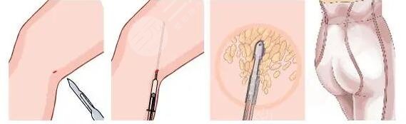 腿部吸脂手術(shù)多少錢一次啊？腿部吸脂手術(shù)潛在的危害有哪些？