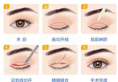 湖南雅美切雙眼皮好嗎?
