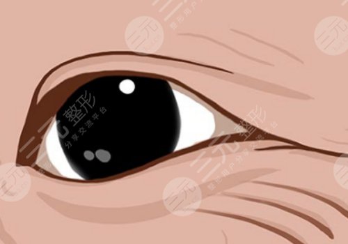 怎么樣去除眼部皺紋？
