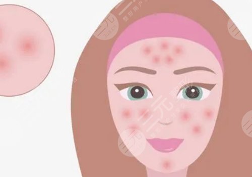 臉上有痘印怎么辦才能去掉呢？
