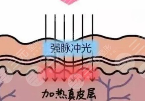 彩光嫩膚和光子嫩膚有什么區(qū)別？