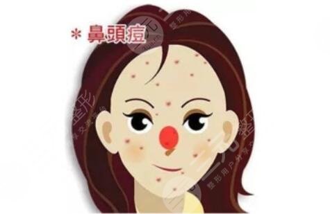 激光緩解鼻子痤瘡注意事項有哪些?