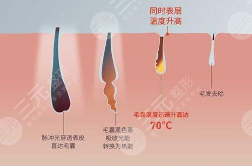 男士激光脫毛效果如何？