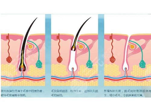 男士激光脫毛效果如何？