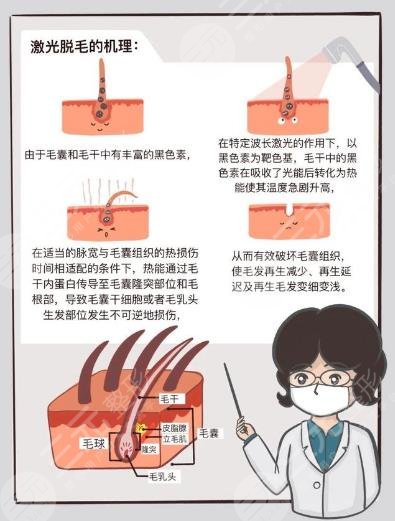 男士激光脫毛效果如何？