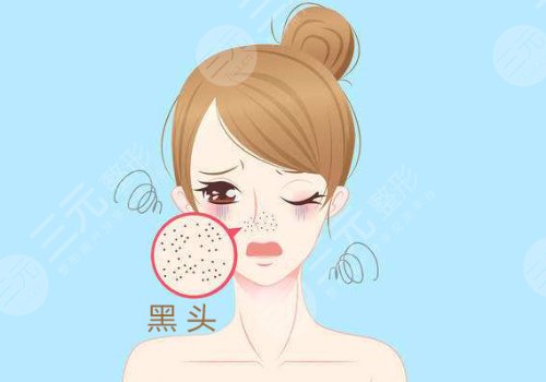 黑頭怎么去除有效？