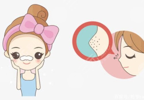 黑頭怎么去除有效？