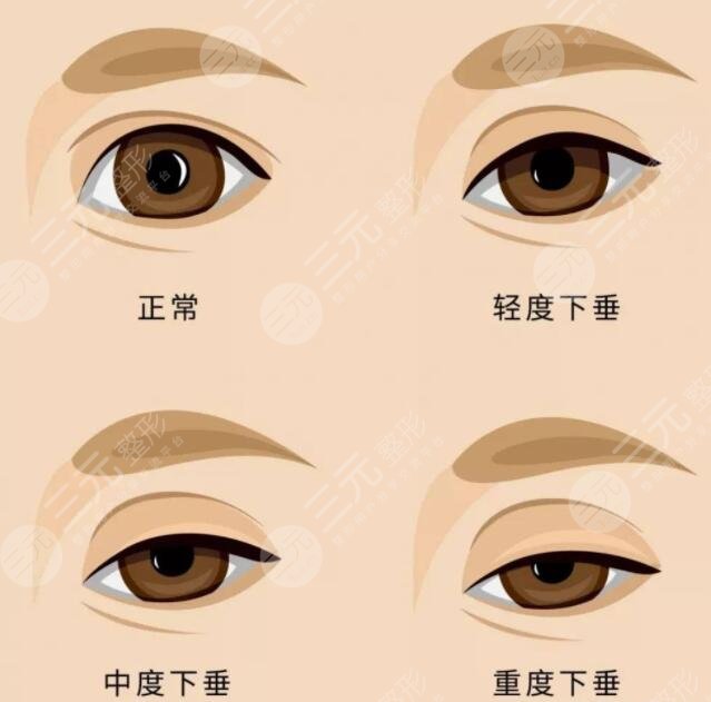上瞼下垂矯正手術(shù)一般多少錢？價格決定因素有2點！