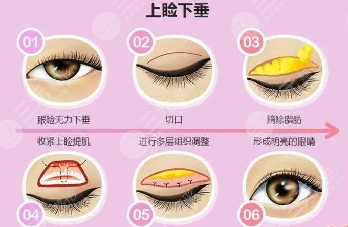 上瞼下垂矯正難嗎?
