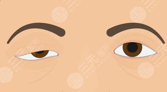 上瞼下垂矯正手術(shù)有風(fēng)險嗎?