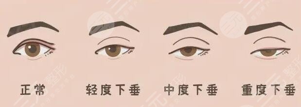 上瞼下垂矯正手術(shù)需要注意哪些問題?