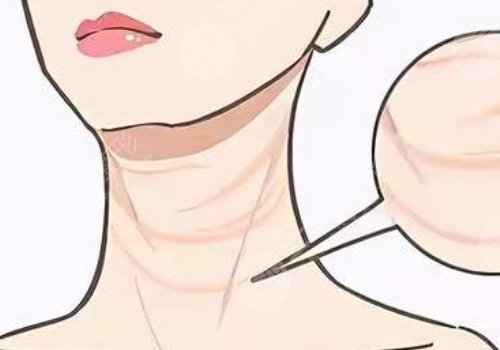 頸紋填充能維持多久呢？色素沉著能消退嗎？