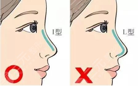 膨體隆鼻的缺點(diǎn)有哪些？多少錢|怎么護(hù)理？